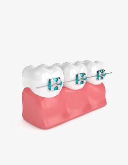 Braces-Orthodontic-Dr-Noeen-Islamabad